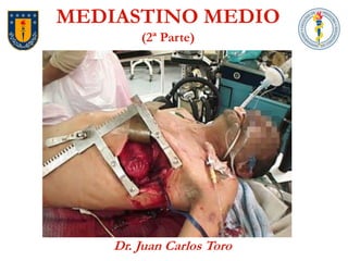 Dr. Juan Carlos Toro 
MEDIASTINO MEDIO(2ª Parte)  