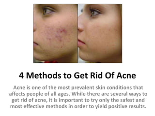 4 Methods to Get Rid Of Acne
  Acne is one of the most prevalent skin conditions that
affects people of all ages. While there are several ways to
 get rid of acne, it is important to try only the safest and
most effective methods in order to yield positive results.
 