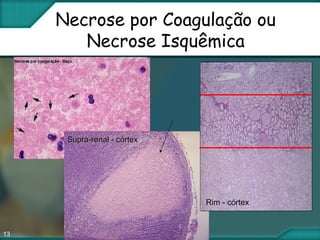13
Necrose por Coagulação ou
Necrose Isquêmica
Supra-renal - córtexSupra-renal - córtex
Rim - córtexRim - córtex
 