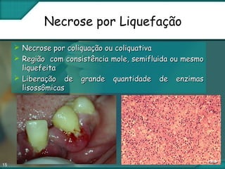 15
Necrose por Liquefação
 Necrose por coliquação ou coliquativaNecrose por coliquação ou coliquativa
 Região com consistência mole, semifluida ou mesmoRegião com consistência mole, semifluida ou mesmo
liquefeitaliquefeita
 Liberação de grande quantidade de enzimasLiberação de grande quantidade de enzimas
lisossômicaslisossômicas
 