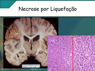 16
Necrose por Liquefação
 
