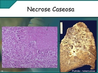 18
Necrose Caseosa
Pulmão - tuberculose
 