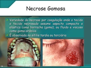 19
Necrose Gomosa
 Variedade da necrose por coagulação onde o tecidoVariedade da necrose por coagulação onde o tecido
o tecido necrosado assume aspecto compacto eo tecido necrosado assume aspecto compacto e
elástico como borracha (goma), ou fluido e viscosoelástico como borracha (goma), ou fluido e viscoso
como goma-arábicacomo goma-arábica
 É observada na sífilis tardia ou terciáriaÉ observada na sífilis tardia ou terciária
 