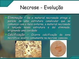 24
Necrose - Evolução
 Eliminação –Eliminação – Se o material necrosado atinge aSe o material necrosado atinge a
parede de uma estrutura canalicular que separede de uma estrutura canalicular que se
comunica com o meio externo, o material necrosadocomunica com o meio externo, o material necrosado
é lançado nessa estrutura e daí eliminado,é lançado nessa estrutura e daí eliminado,
originando uma cavidadeoriginando uma cavidade
 Calcificação –Calcificação – Ocorre calcificação da zonaOcorre calcificação da zona
necrótica; ocorre comumente na necrose caseosa.necrótica; ocorre comumente na necrose caseosa.
 