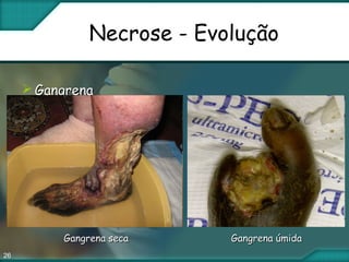 26
Necrose - Evolução
 GangrenaGangrena
Gangrena secaGangrena seca Gangrena úmidaGangrena úmida
 