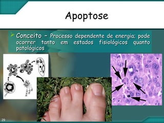 29
Apoptose
 ConceitoConceito –– Processo dependente de energia; podeProcesso dependente de energia; pode
ocorrer tanto em estados fisiológicos quantoocorrer tanto em estados fisiológicos quanto
patológicospatológicos
 