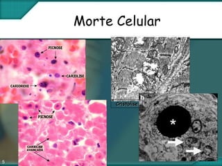 5
Morte Celular
CristóliseCristólise
 