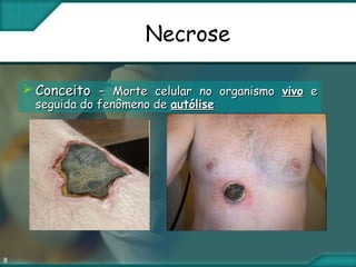 8
Necrose
 Conceito -Conceito - Morte celular no organismoMorte celular no organismo vivovivo ee
seguida do fenômeno deseguida do fenômeno de autóliseautólise
 