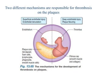 Two different mechanisms are responsible for thrombosis
on the plaques
 