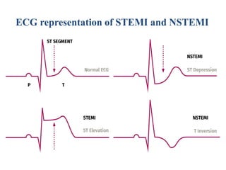ECG representation of STEMI and NSTEMI
 