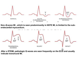 After a STEMI, pathologic Q waves are seen frequently on the ECG and usually
indicate transmural MI.
Non–Q-wave MI , which is seen predominantly in NSTE MI, is limited to the sub-
endocardial myocardium.
 