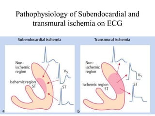 Pathophysiology of Subendocardial and
transmural ischemia on ECG
 