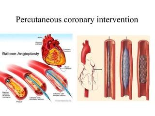 Percutaneous coronary intervention
 