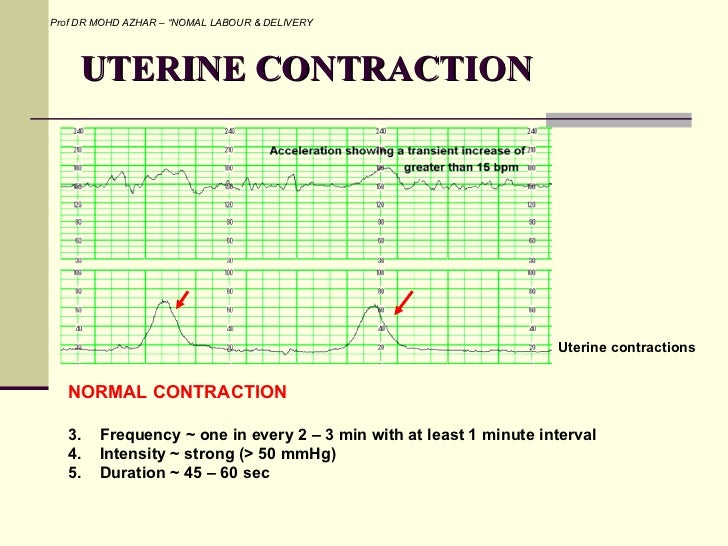 Labour Contractions Timing Chart