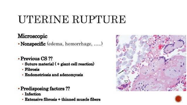 postpartum retained placental fragments defined postpartum retained placental fragments defined