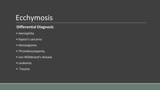 Ecchymosis
Differential Diagnosis
• Hemophilia
• Kaposi’s sarcoma
• Hemangioma
• Thrombocytopenia,
• von Willebrand’s disease
• Leukemia
• Trauma
 