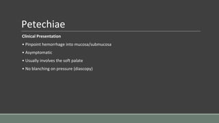 Petechiae
Clinical Presentation
• Pinpoint hemorrhage into mucosa/submucosa
• Asymptomatic
• Usually involves the soft palate
• No blanching on pressure (diascopy)
 