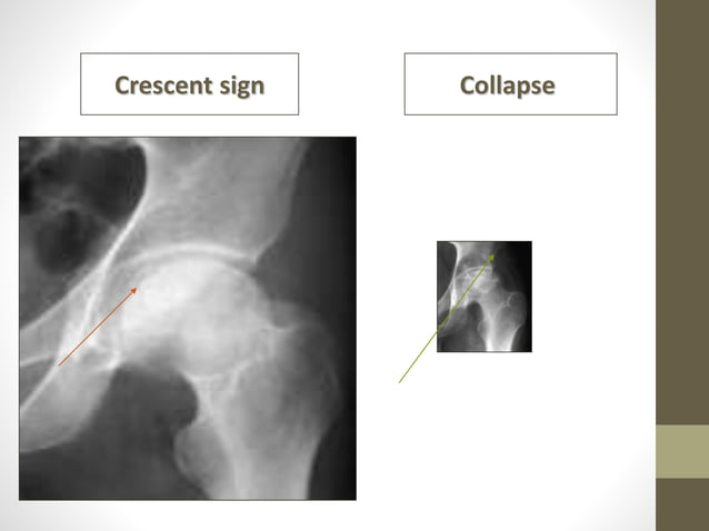 Avascular necrosis of femoral head classification | PPTX