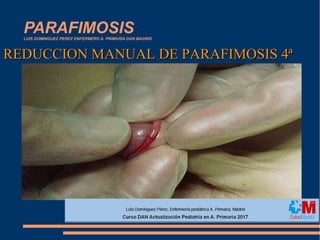 PARAFIMOSISLUIS DOMINGUEZ PEREZ ENFERMERO A. PRIMARIA DAN MADRID
QUE ES ???????????QUE ES ???????????
REDUCCION MANUAL DE PARAFIMOSIS 4ªREDUCCION MANUAL DE PARAFIMOSIS 4ª
 