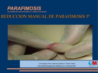 PARAFIMOSISLUIS DOMINGUEZ PEREZ ENFERMERO A. PRIMARIA DAN MADRID
REDUCCION MANUAL DE PARAFIMOSIS 5ªREDUCCION MANUAL DE PARAFIMOSIS 5ª
 