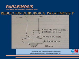 PARAFIMOSISLUIS DOMINGUEZ PEREZ ENFERMERO A. PRIMARIA DAN MADRID
REDUCCION QUIRURGICA PARAFIMOSIS 1ªREDUCCION QUIRURGICA PARAFIMOSIS 1ª
 