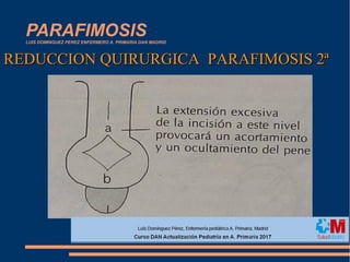 PARAFIMOSISLUIS DOMINGUEZ PEREZ ENFERMERO A. PRIMARIA DAN MADRID
REDUCCION QUIRURGICA PARAFIMOSIS 2ªREDUCCION QUIRURGICA PARAFIMOSIS 2ª
 