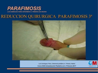 PARAFIMOSISLUIS DOMINGUEZ PEREZ ENFERMERO A. PRIMARIA DAN MADRID
REDUCCION QUIRURGICA PARAFIMOSIS 3ªREDUCCION QUIRURGICA PARAFIMOSIS 3ª
 