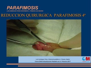 PARAFIMOSISLUIS DOMINGUEZ PEREZ ENFERMERO A. PRIMARIA DAN MADRID
REDUCCION QUIRURGICA PARAFIMOSIS 4ªREDUCCION QUIRURGICA PARAFIMOSIS 4ª
 