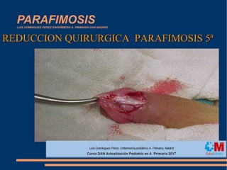 PARAFIMOSISLUIS DOMINGUEZ PEREZ ENFERMERO A. PRIMARIA DAN MADRID
REDUCCION QUIRURGICA PARAFIMOSIS 5ªREDUCCION QUIRURGICA PARAFIMOSIS 5ª
 