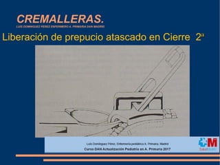 CREMALLERAS.LUIS DOMINGUEZ PEREZ ENFERMERO A. PRIMARIA DAN MADRID
Liberación de prepucio atascado en Cierre 2ªª
 