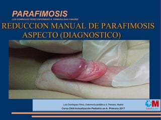 PARAFIMOSISLUIS DOMINGUEZ PEREZ ENFERMERO A. PRIMARIA DAN V MADRID
REDUCCION MANUAL DE PARAFIMOSISREDUCCION MANUAL DE PARAFIMOSIS
ASPECTO (DIAGNOSTICO)ASPECTO (DIAGNOSTICO)
 