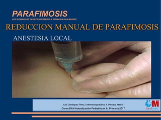 PARAFIMOSISLUIS DOMINGUEZ PEREZ ENFERMERO A. PRIMARIA DAN MADRID
REDUCCION MANUAL DE PARAFIMOSISREDUCCION MANUAL DE PARAFIMOSIS
ANESTESIA LOCAL
 