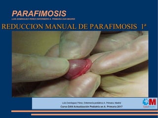 PARAFIMOSISLUIS DOMINGUEZ PEREZ ENFERMERO A. PRIMARIA DAN MADRID
REDUCCION MANUAL DE PARAFIMOSIS 1ªREDUCCION MANUAL DE PARAFIMOSIS 1ª
 