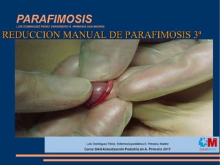 PARAFIMOSISLUIS DOMINGUEZ PEREZ ENFERMERO A. PRIMARIA DAN MADRID
REDUCCION MANUAL DE PARAFIMOSIS 3ªREDUCCION MANUAL DE PARAFIMOSIS 3ª
 