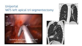 Management of pulmonary tuberculosis is a place for surgery_rus | PDF