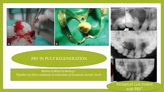 Periapical cyst treated
with PRF7
PRF IN PULP REGENERATION
Mishra N,Mittal N,Narang I.
Platelet-rich fibrin-mediated revitalization of immature necrotic tooth
 