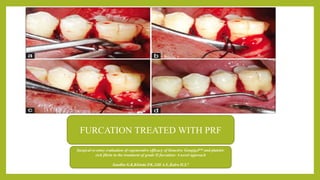 FURCATION TREATED WITH PRF
Surgical re-entry evaluation of regenerative efficacy of bioactive Gengigel™ and platelet-
rich fibrin in the treatment of grade II furcation: A novel approach
Sandhu G.K,Khinda P.K.,Gill A.S.,Kalra H.S.8
 