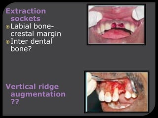 Extraction
sockets
Labial bone-
crestal margin
Inter dental
bone?
Vertical ridge
augmentation
??
 