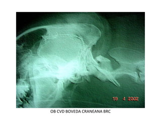 OB CVD BOVEDA CRANEANA BRC
 