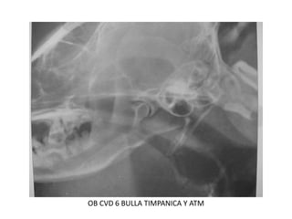 OB CVD 6 BULLA TIMPANICA Y ATM
 