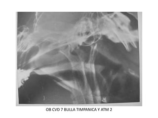 OB CVD 7 BULLA TIMPANICA Y ATM 2
 