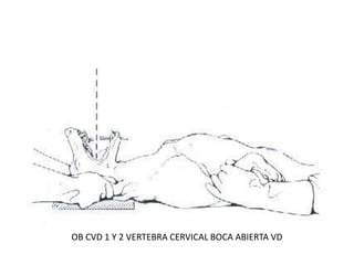 OB CVD 1 Y 2 VERTEBRA CERVICAL BOCA ABIERTA VD
 