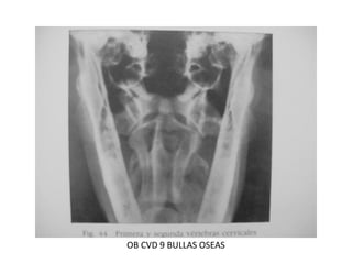 OB CVD 9 BULLAS OSEAS
 