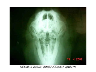 OB CVD 10 VISTA AP CON BOCA ABIERTA SENOS PN
 