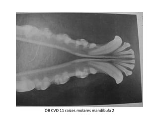 OB CVD 11 raices molares mandibula 2
 