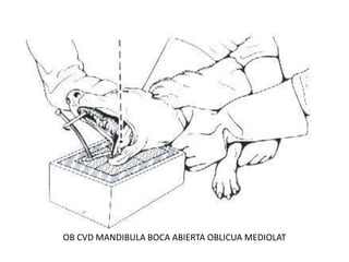 OB CVD MANDIBULA BOCA ABIERTA OBLICUA MEDIOLAT
 