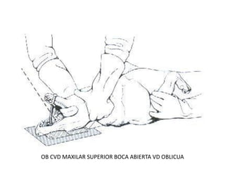 OB CVD MAXILAR SUPERIOR BOCA ABIERTA VD OBLICUA
 