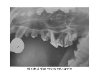 OB CVD 15 raices molares max. superior
 
