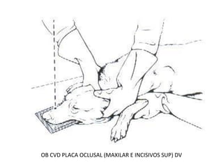 OB CVD PLACA OCLUSAL (MAXILAR E INCISIVOS SUP) DV
 