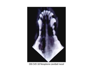 OB CVD 18 Neoplasia cavidad nasal
 